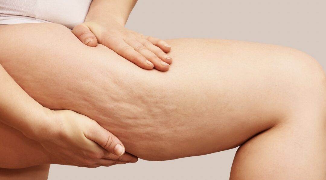 Cellulite “a buccia d’arancia”: come eliminarla